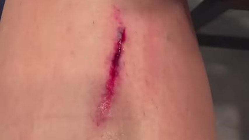 Heidi Klum verletzt sich bei Live-Auftritt schwer "Überall Blut"! Blutige Verletzung live im TV!